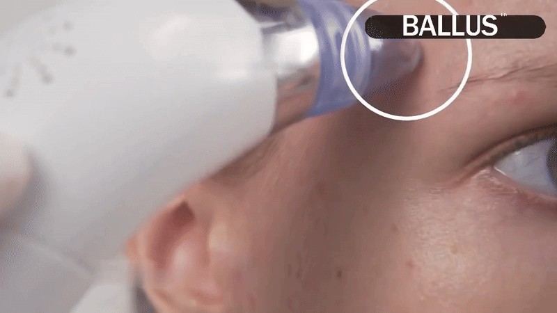 Rechargeable Pre Cleaning Device - Blackhead Remover Vacuum